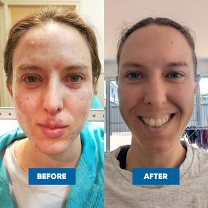 Before and after comparison of a female with visible skin and adult acne improvement from using MooGoo Milk Wash.